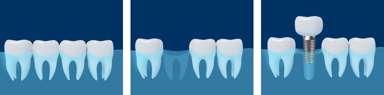 Der Ablauf des Einsetzen eines Sofortimplantats oder Dentalimplantats für Ihre Zähne