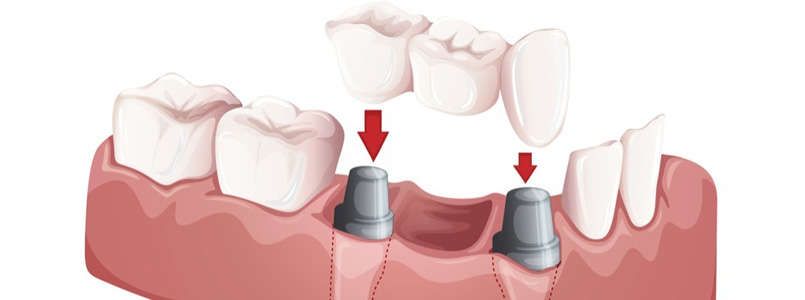Zu sehen ist ein Modell eines Kiefers mit Implantatbrücke.